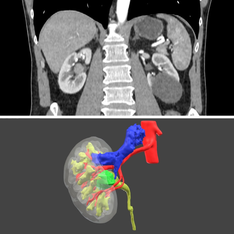 Surgical planning - Digital 3D model for urology
