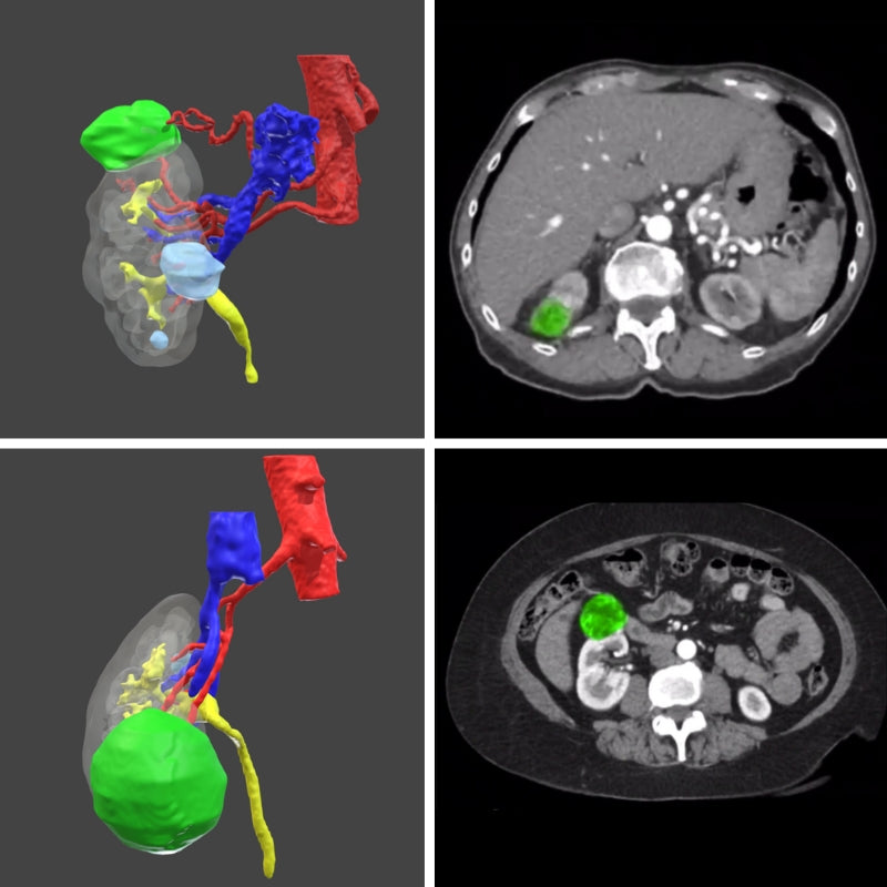 Surgical planning - Digital 3D model for urology