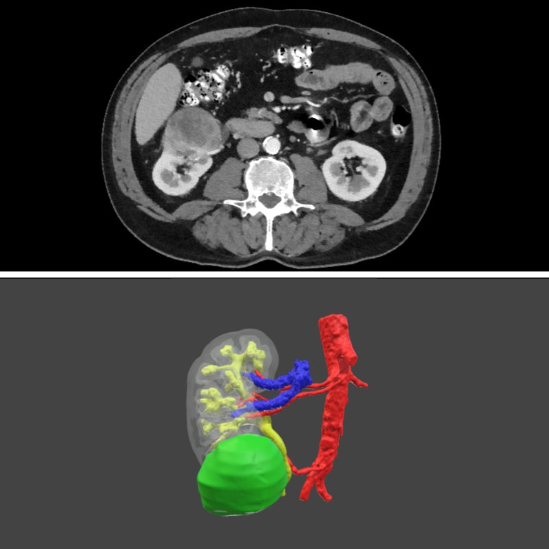 Surgical planning - Digital 3D model for urology